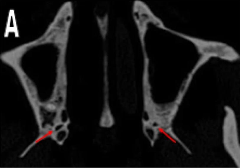 Foramen palatinum minor im CT
