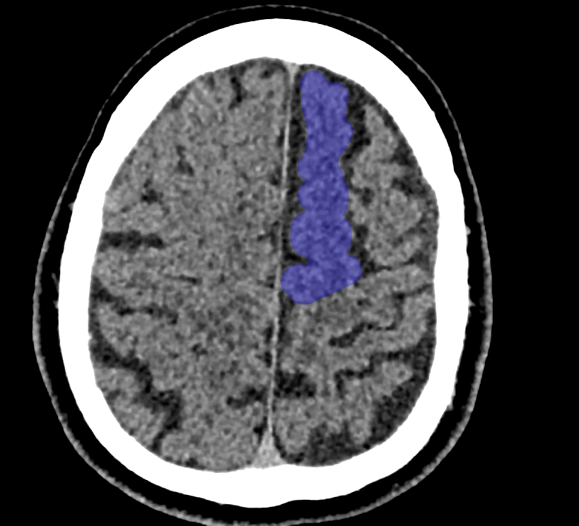 Gyrus frontalis superior CT