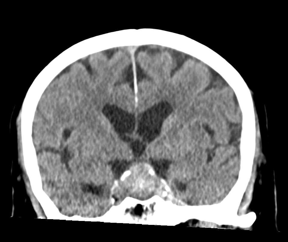 Hypophysenadenom im CT