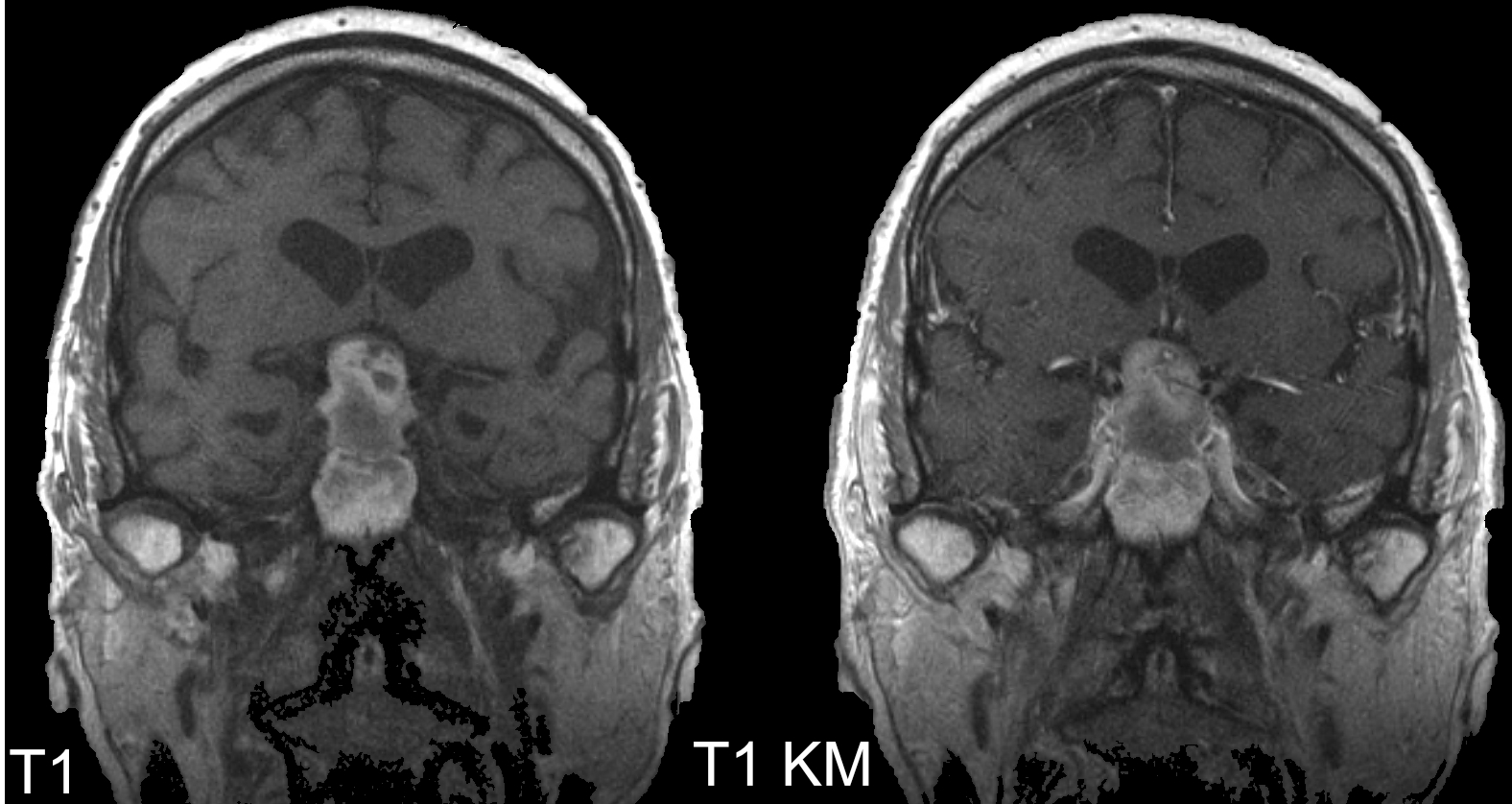 Eingeblutetes Hypophysenmakroadenom
