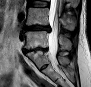 Lumbaler Bandscheibenvorfall sagittal