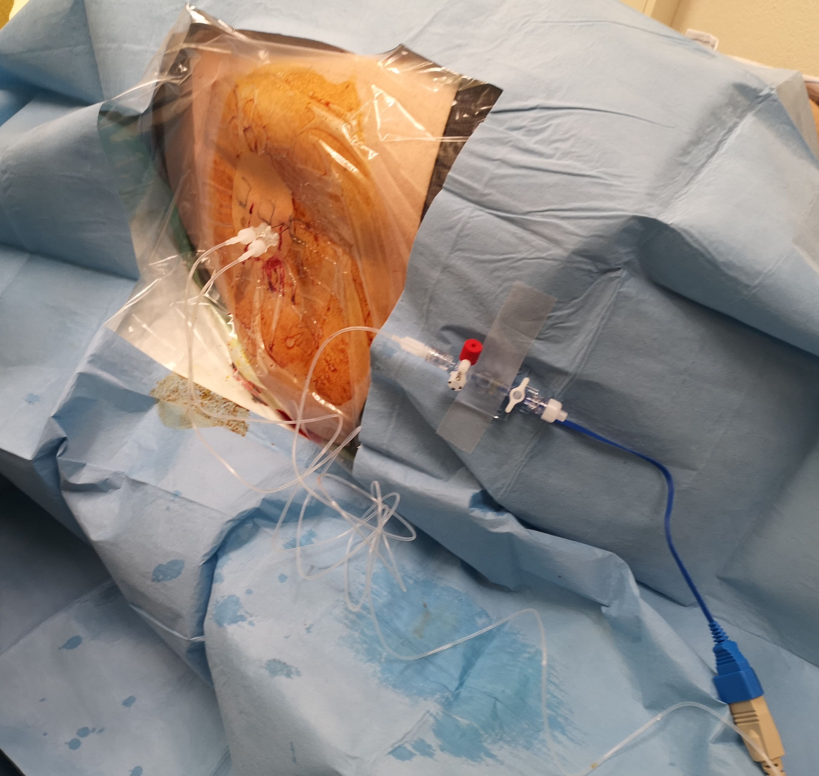 Durchführung eines lumbalen Infusionstest