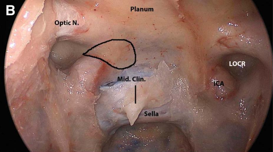 Medial and lateral opticocarotid recess