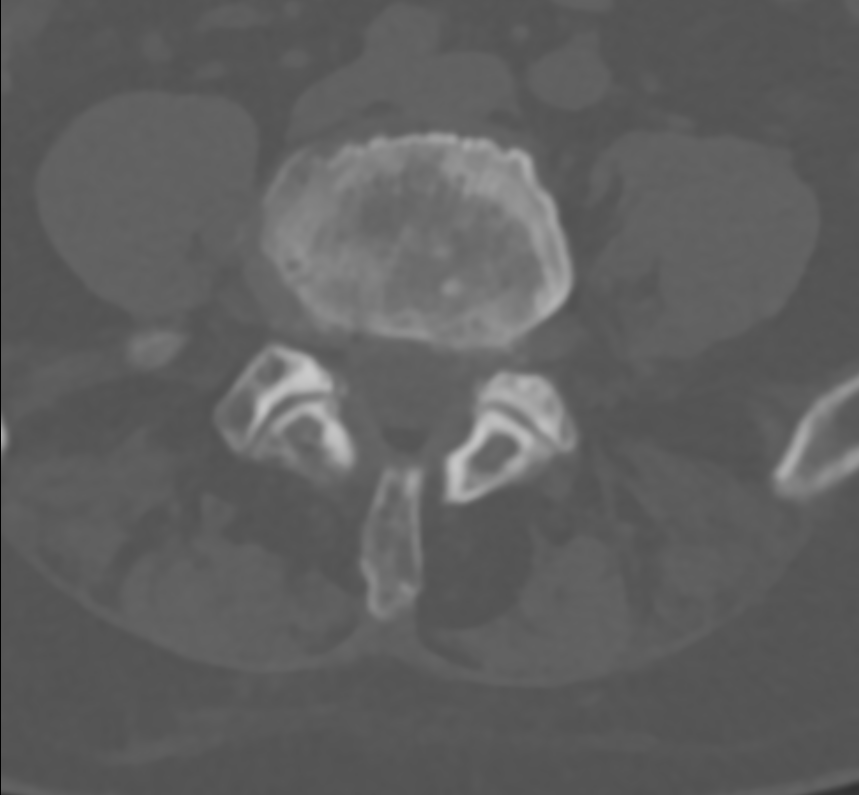 Linksseitige Neuroforamenstenose