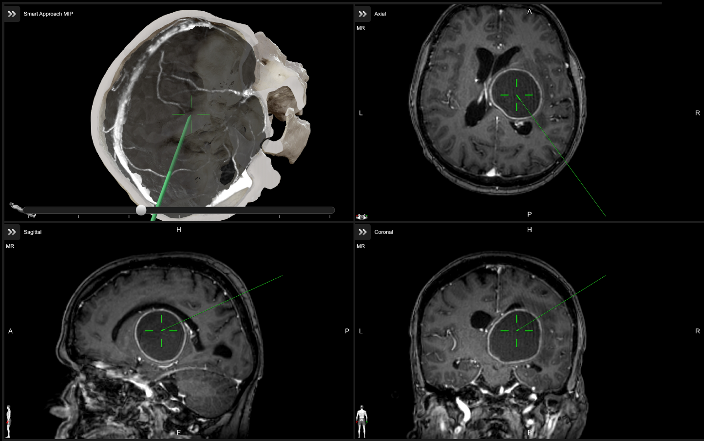 Brainlab Neuronavigation