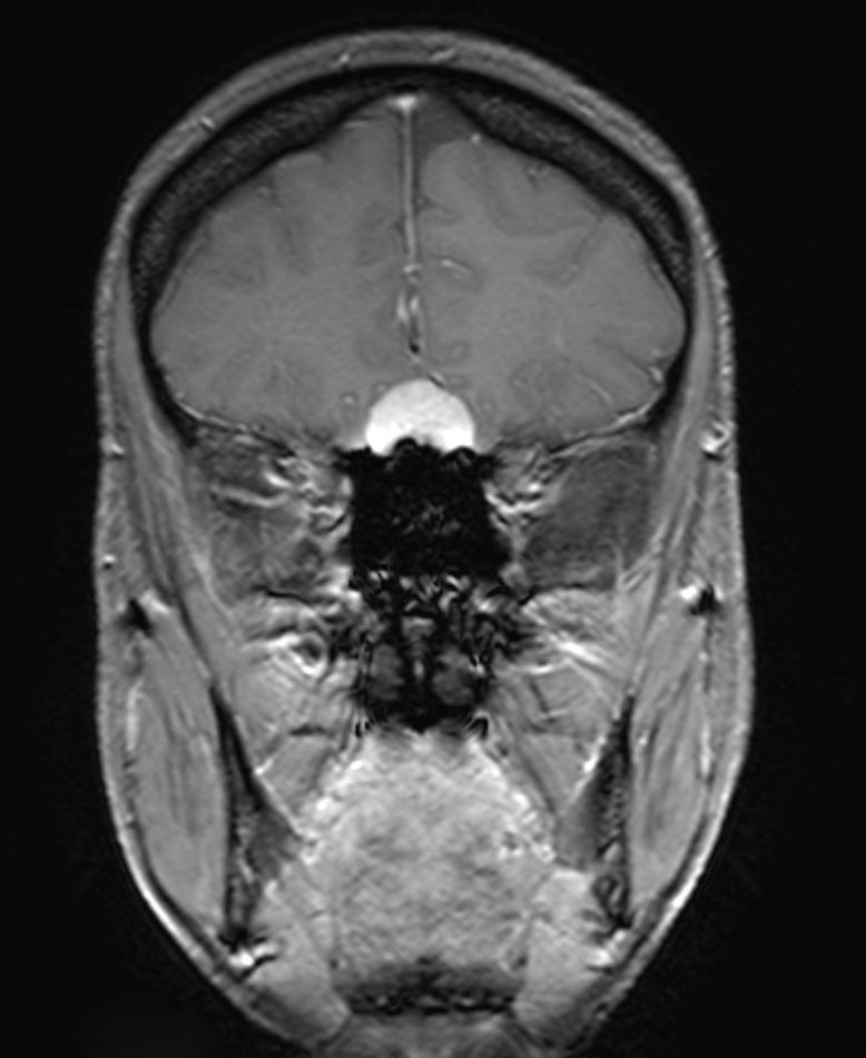 Olfactory meningioma MRI