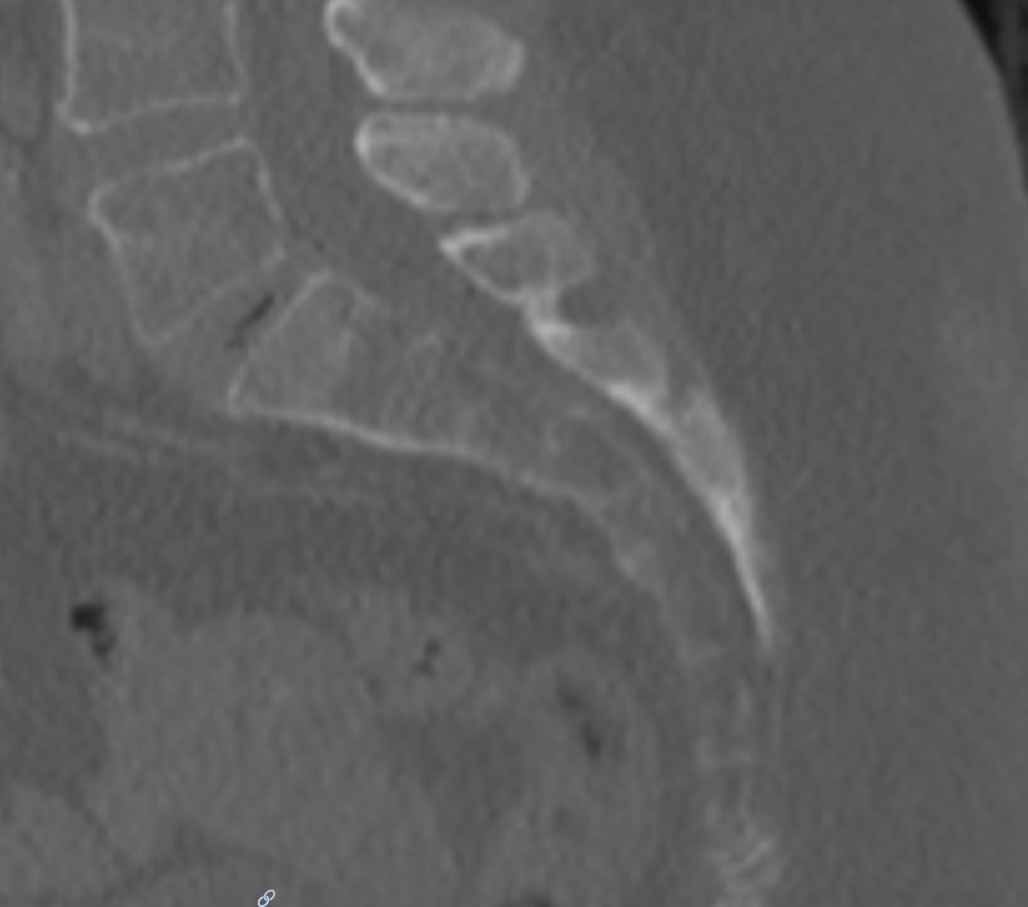 Sagittales CT Bild des Os sacrum