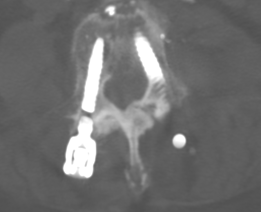 Gebrochene Pedikelschraube CT