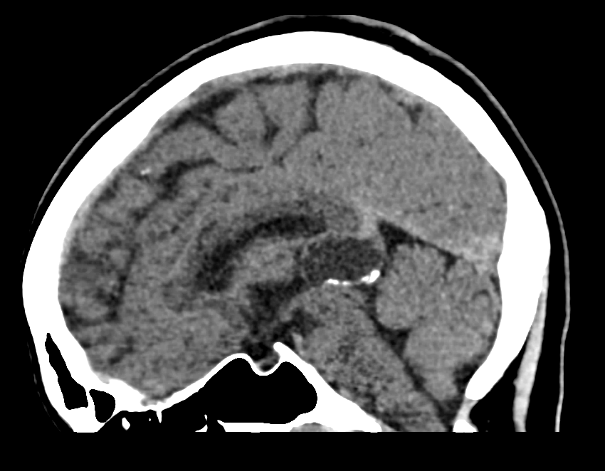 Pineal cyst on a CT