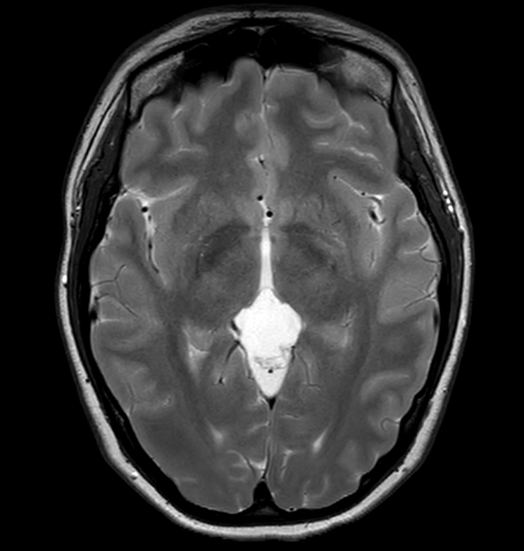 Axial MRI of a pineal cyst