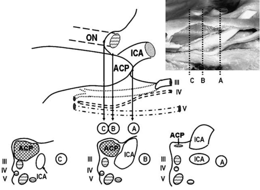 Processus clinoideus anterior