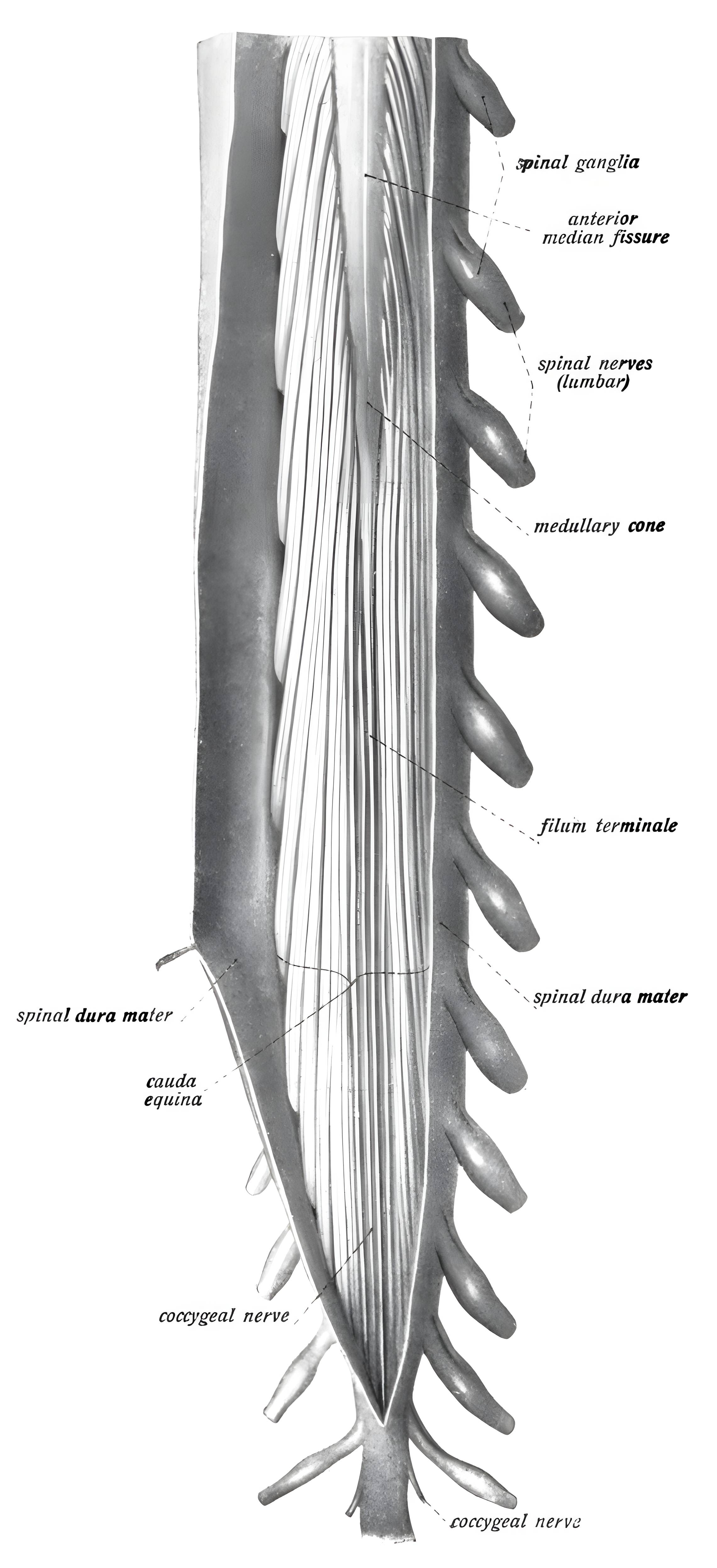 Lumbale Dura mater eröffnet