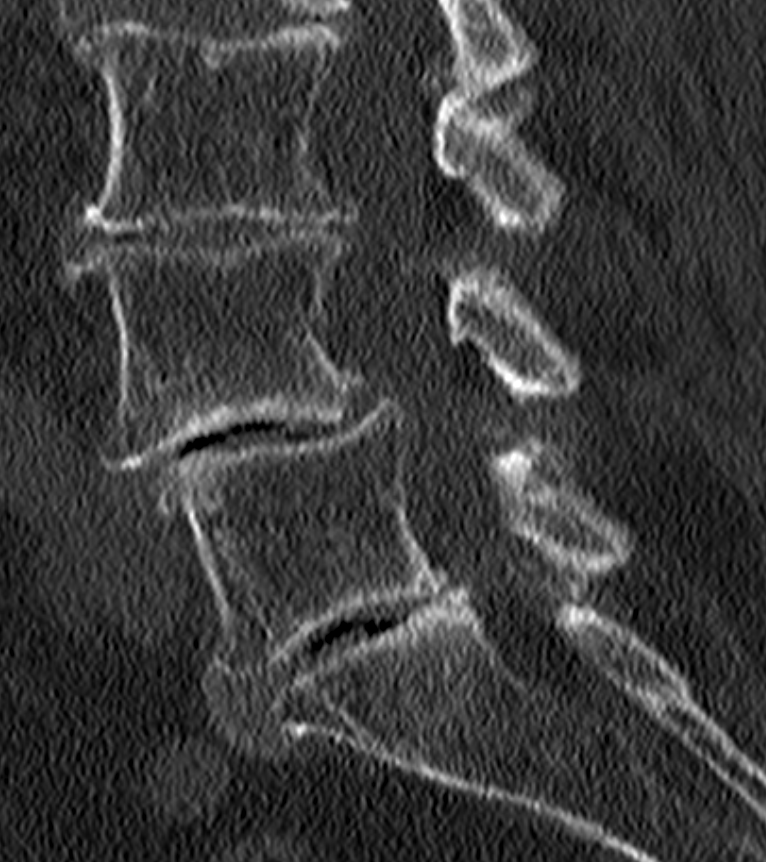 Spondylolisthese LWK 4/5 mit Vakuumphänomen im CT
