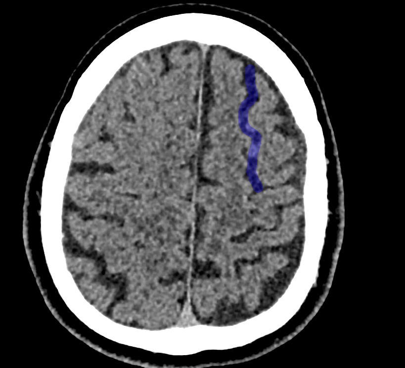 Sulcus frontalis superior im CT
