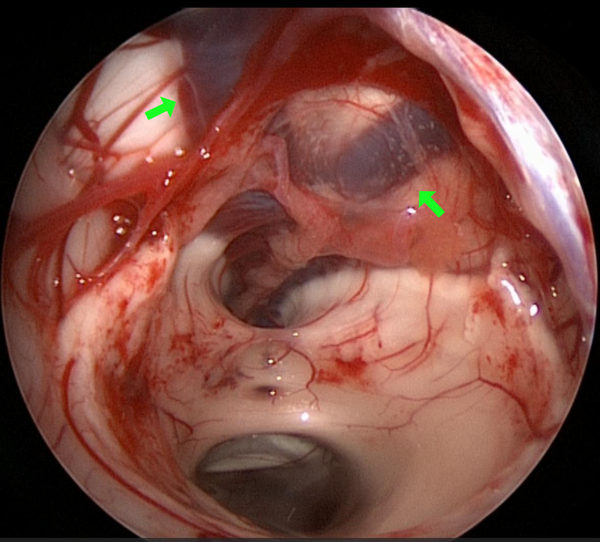 Vena cerebri interna