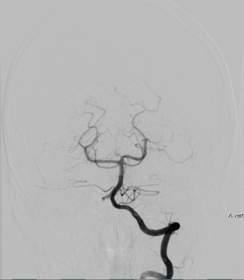 Arteria vertebralis in einer DSA