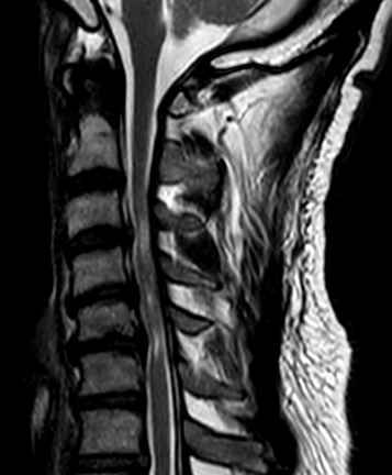 Zervikale Myelopathie MRT