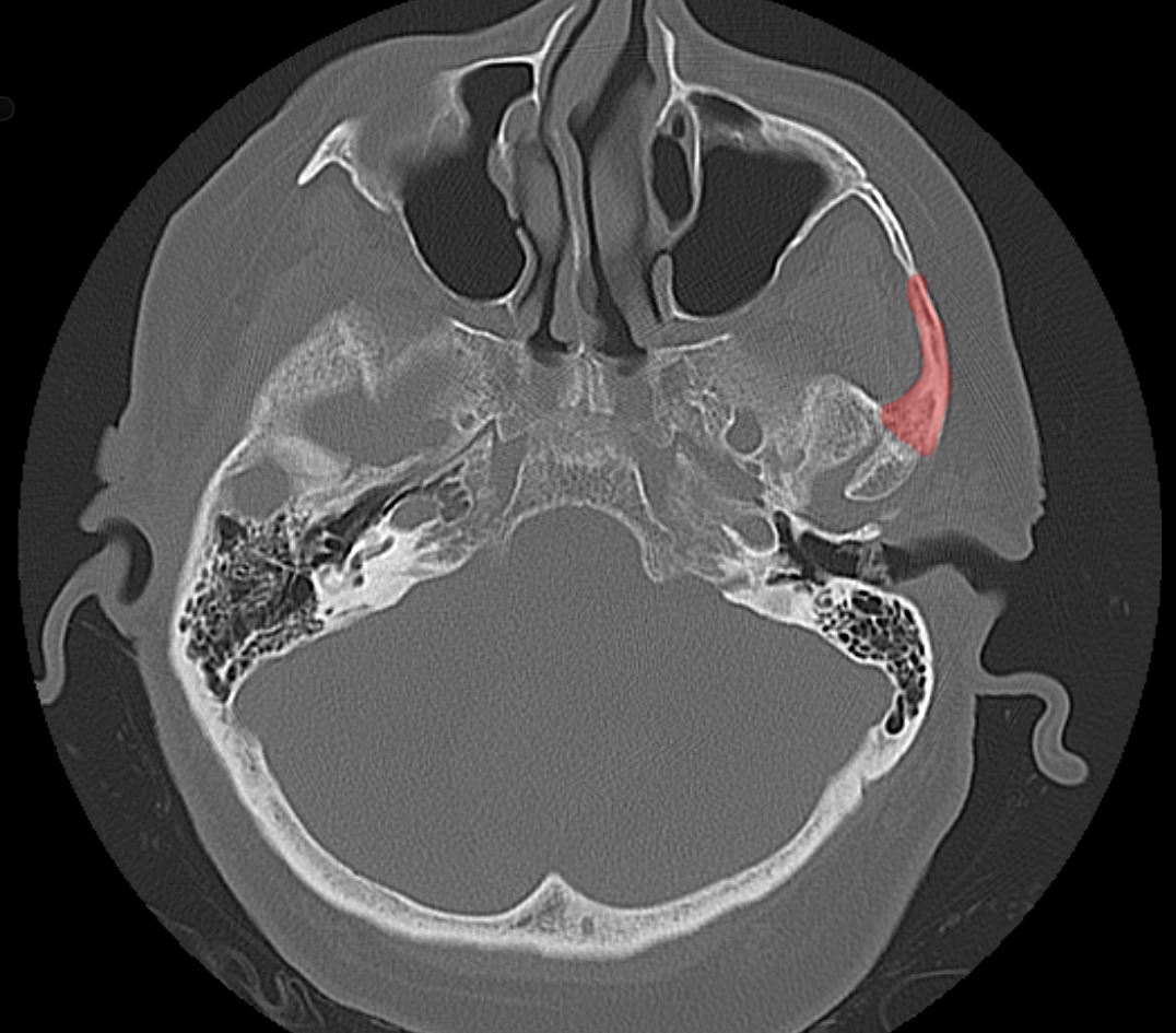 Zygoma CT