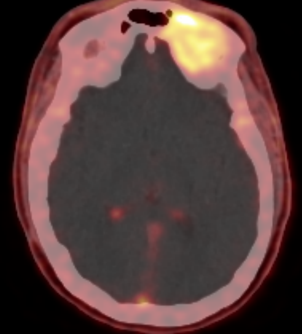 DOTATOC PET CT