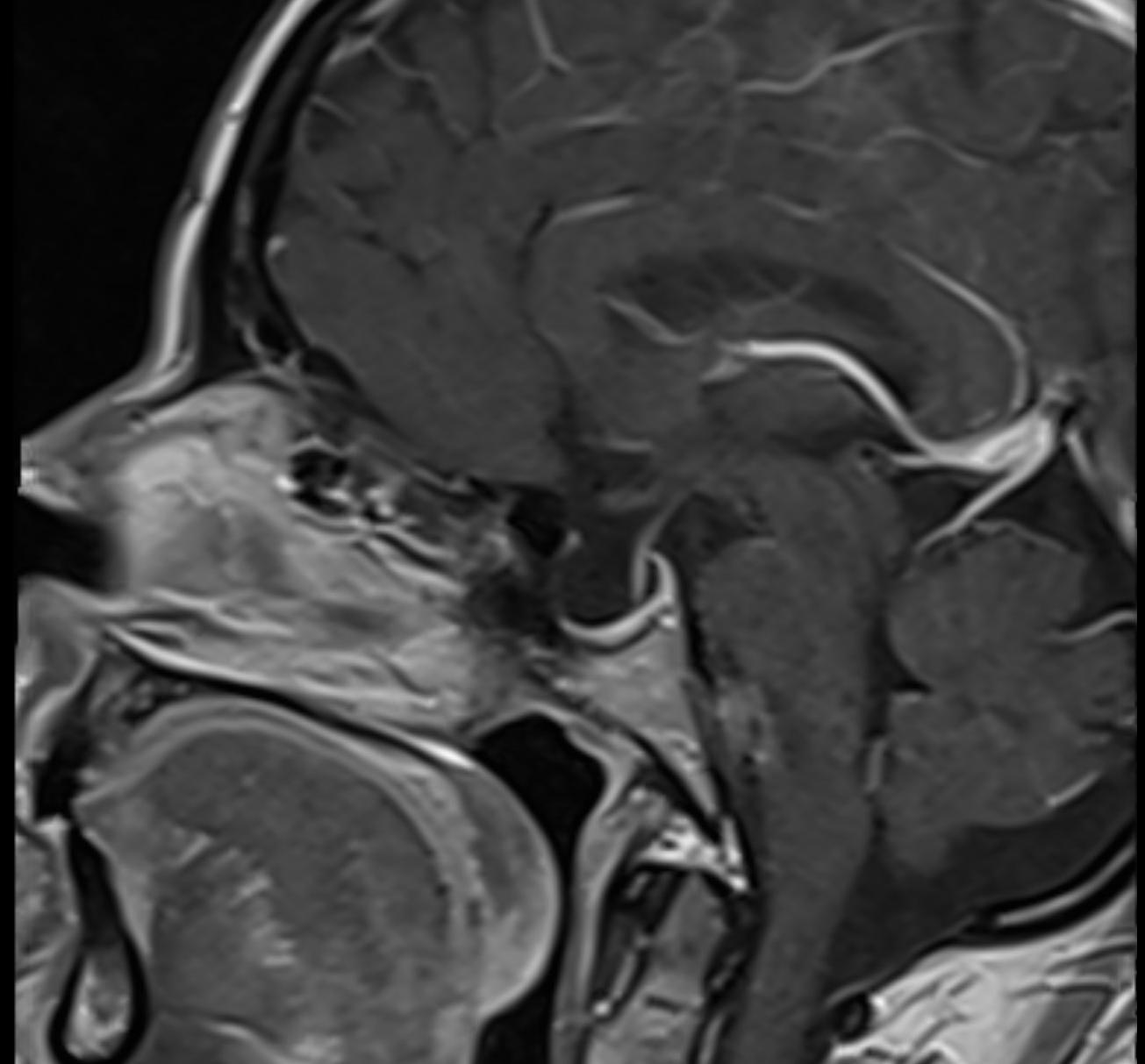 Empty Sella MRT sagittal