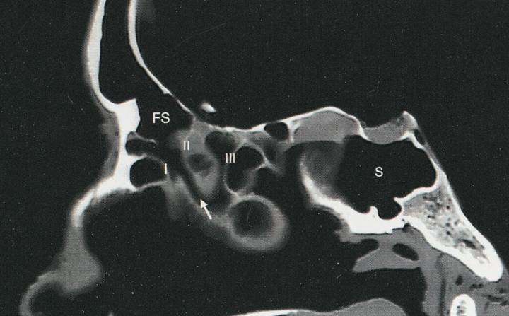 Ductus frontonasalis im CT