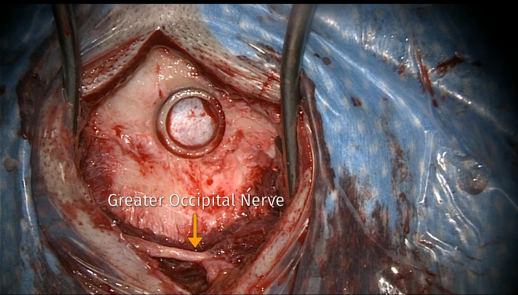 Nervus occipitalis major intraoperativ