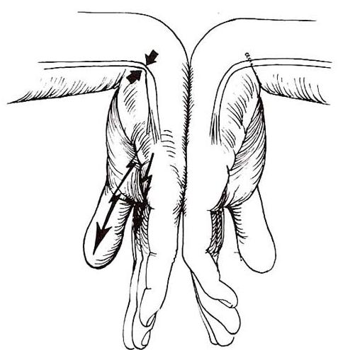 Phalen Test