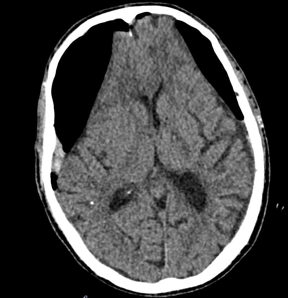 Postoperativer Pneumocephalus