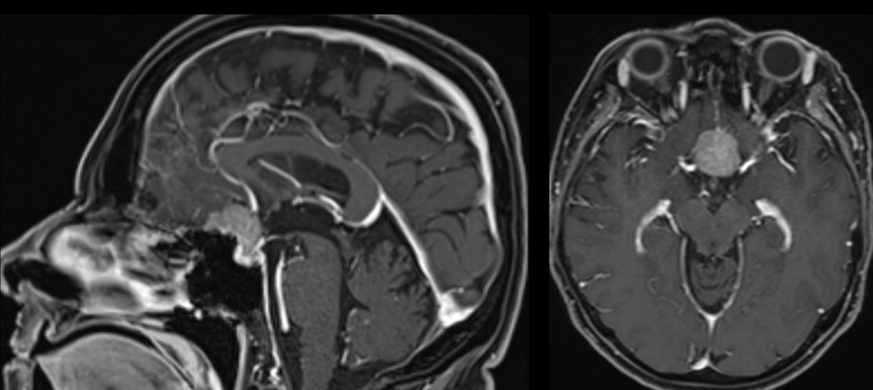 Tuberculum sellae Meningeom MRT