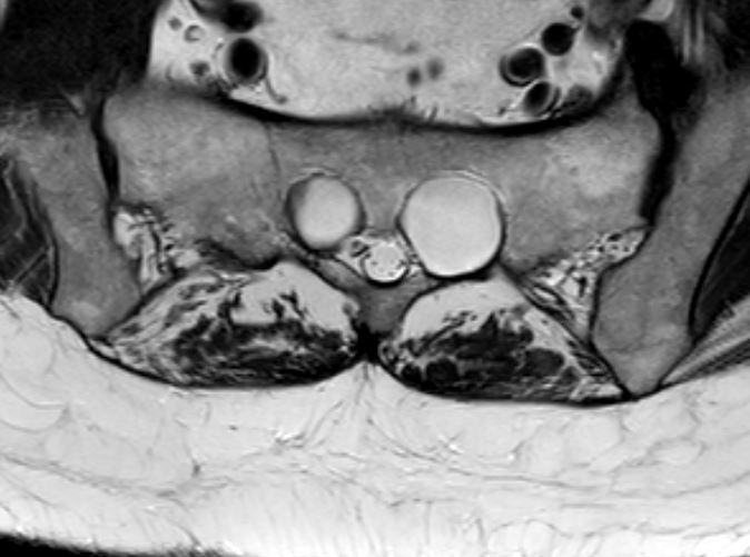 Bilateral sacral perineural cysts