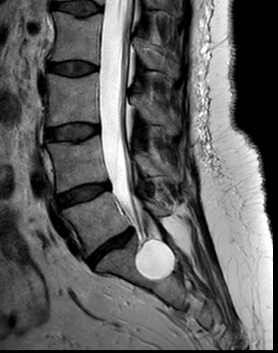Sacral perineural cyst