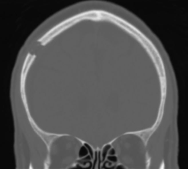 Bohrlochtrepanation CT
