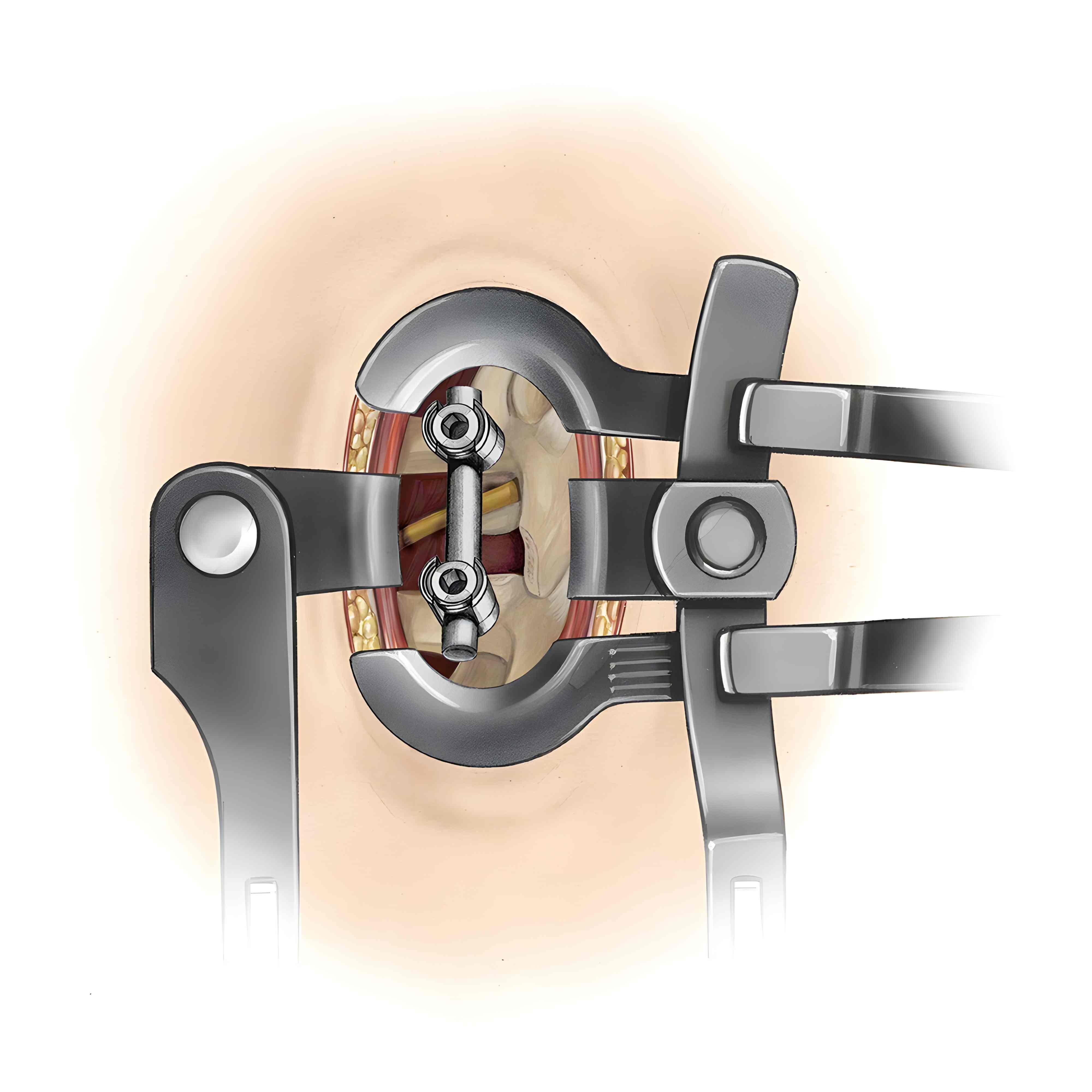 Caspar retractor during spinal