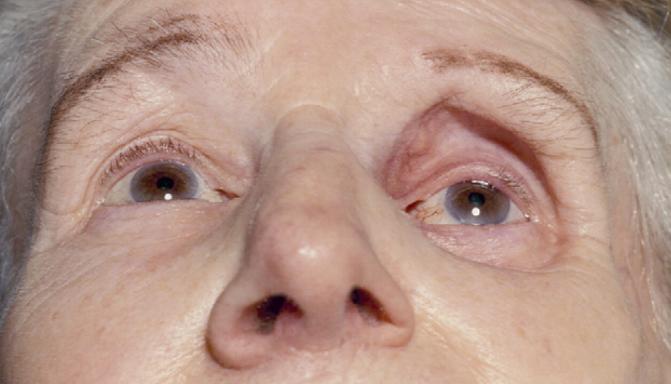 Enophthalmus