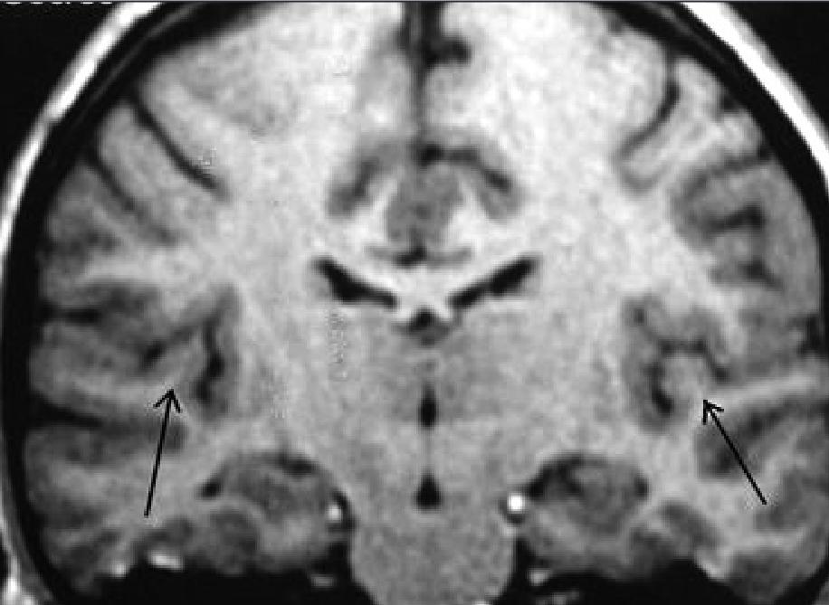 Gyri temporales transversi