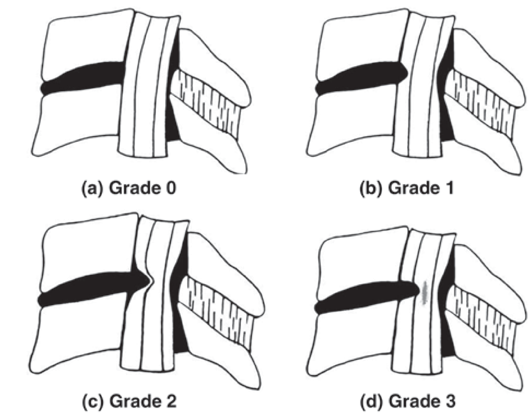 Figure of the Kang classification