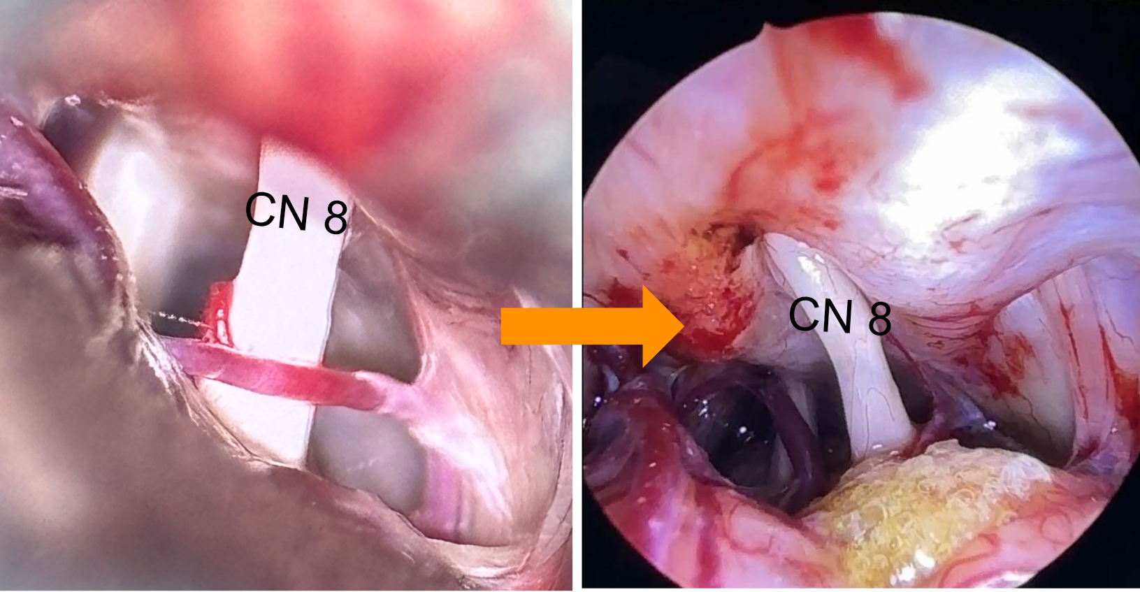 Microvascular decompression for vestibular paroxysmia