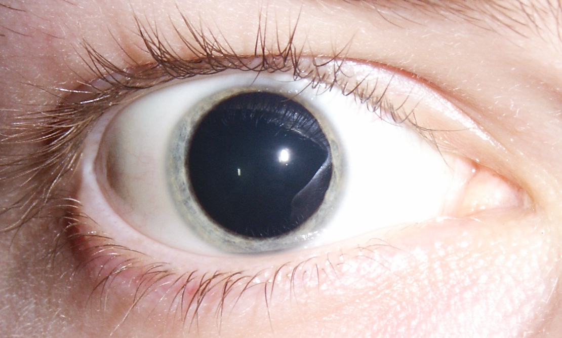 Blown pupil