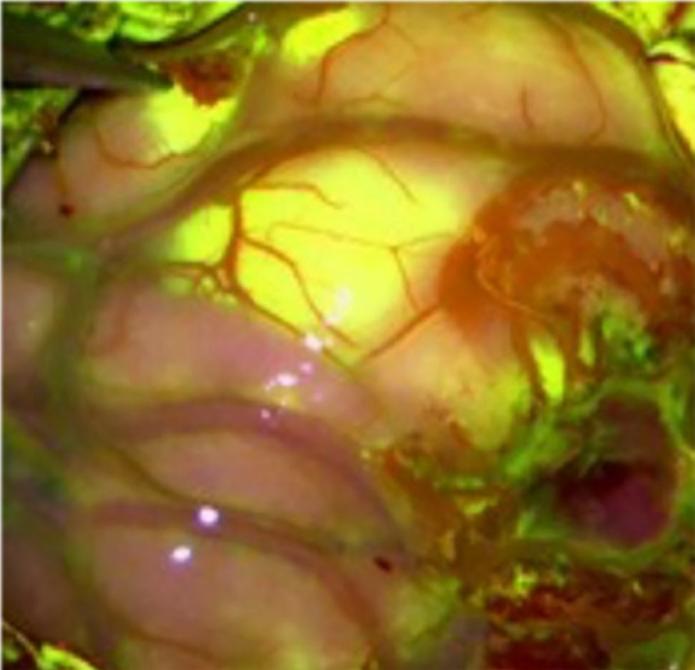 Natriumfluorescein Hirnmetastase