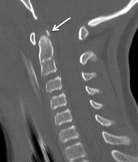 Ossiculum terminale CT