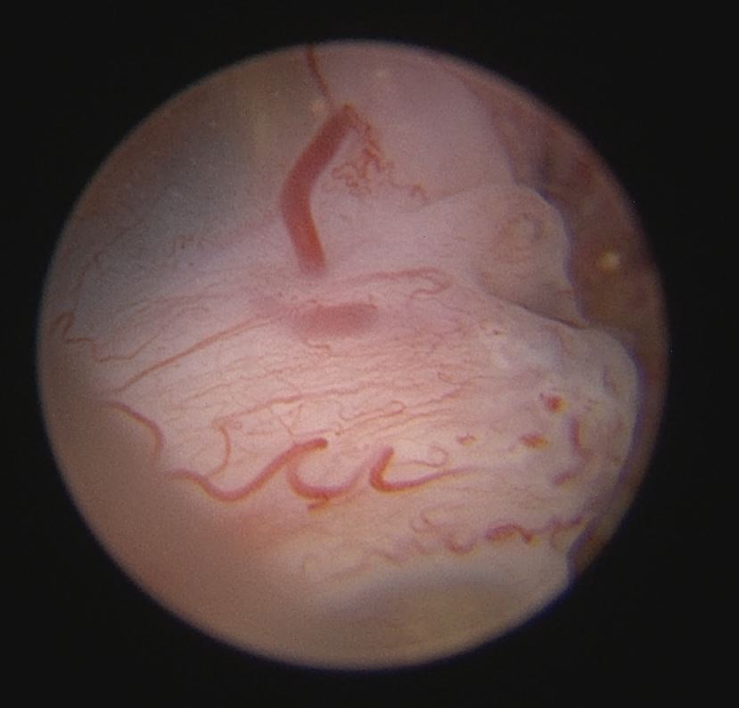 Papillärer Tumor der Pinealisloge endoskopisch