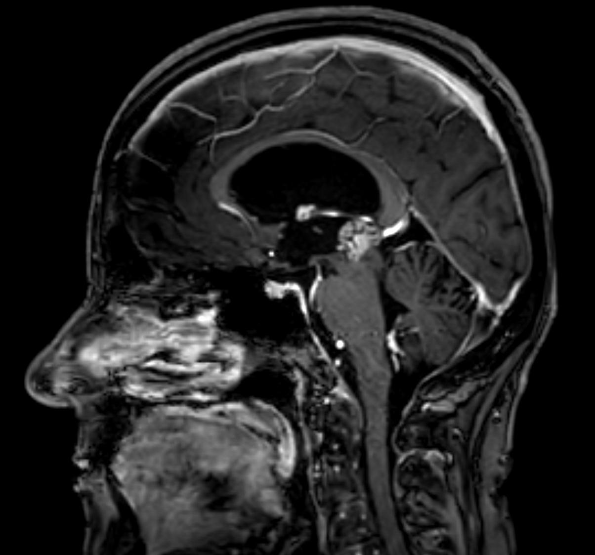 Papillärer Tumor der Pinealisloge MRT