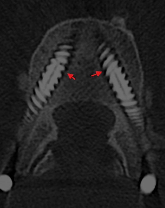 Pedikelschraubenlockerungssaum im CT