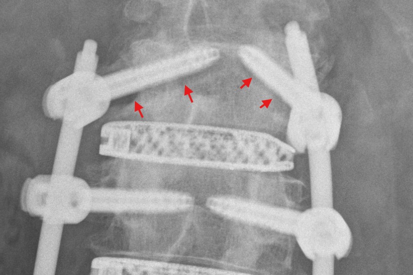 Pedikelschraubenlockerung Röntgen