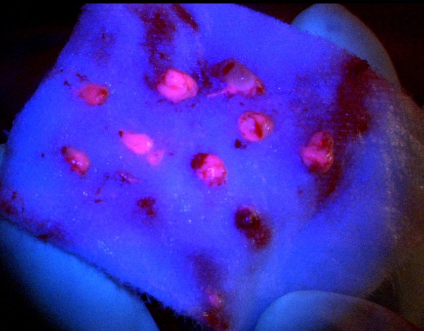 5-ALA positives Gewebe