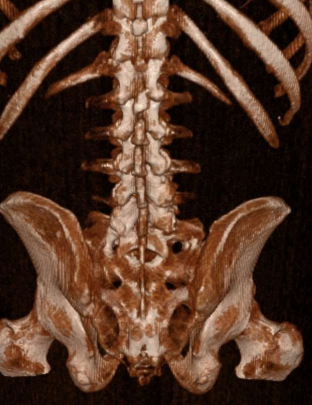 Castellvi Typ 3b Anomalie CT