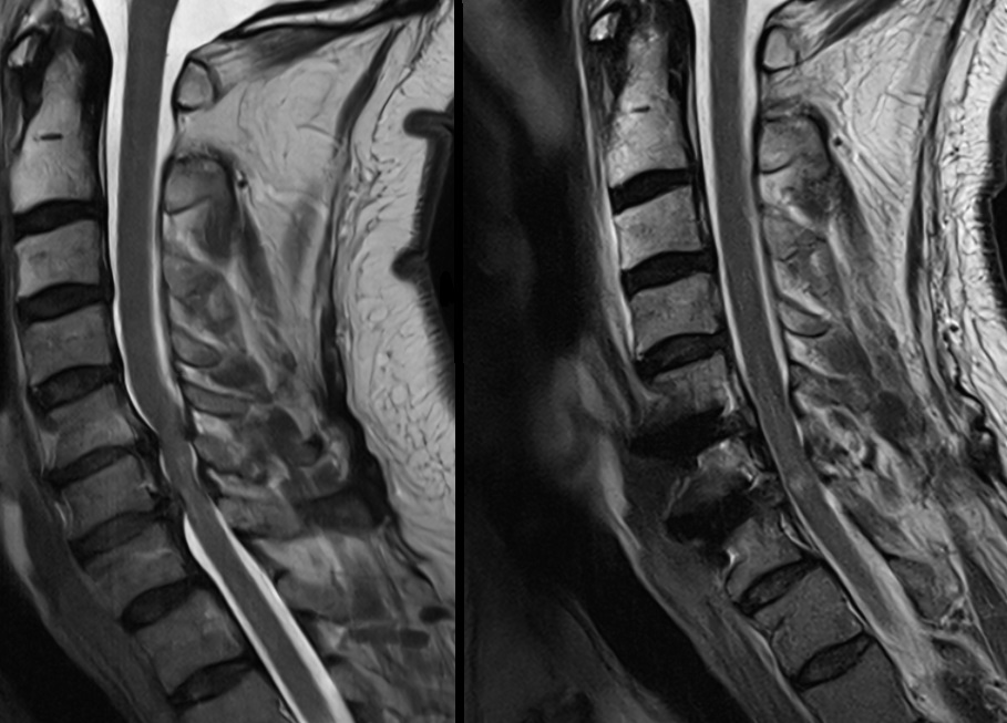 MRT Spinalkanalstenose Central Cord