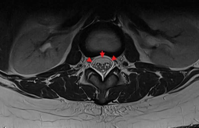 Duradoppelkontur axiales MRi