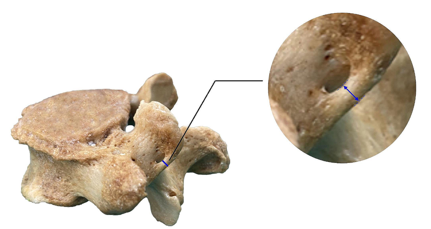 Foramen mamillo-accessorium