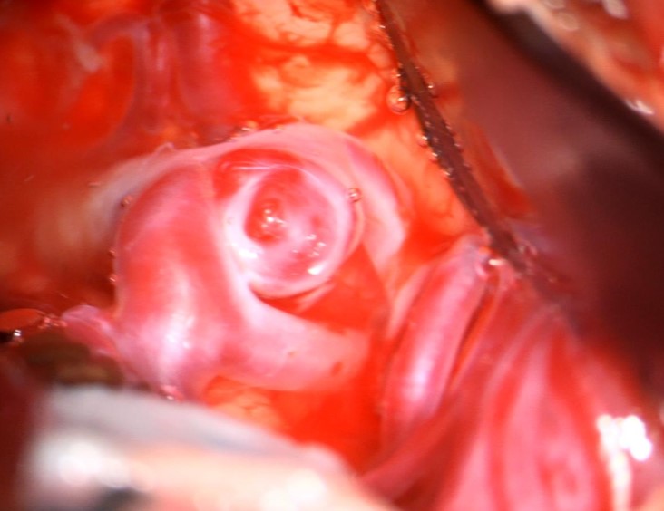Mediabifurkationsaneurysma